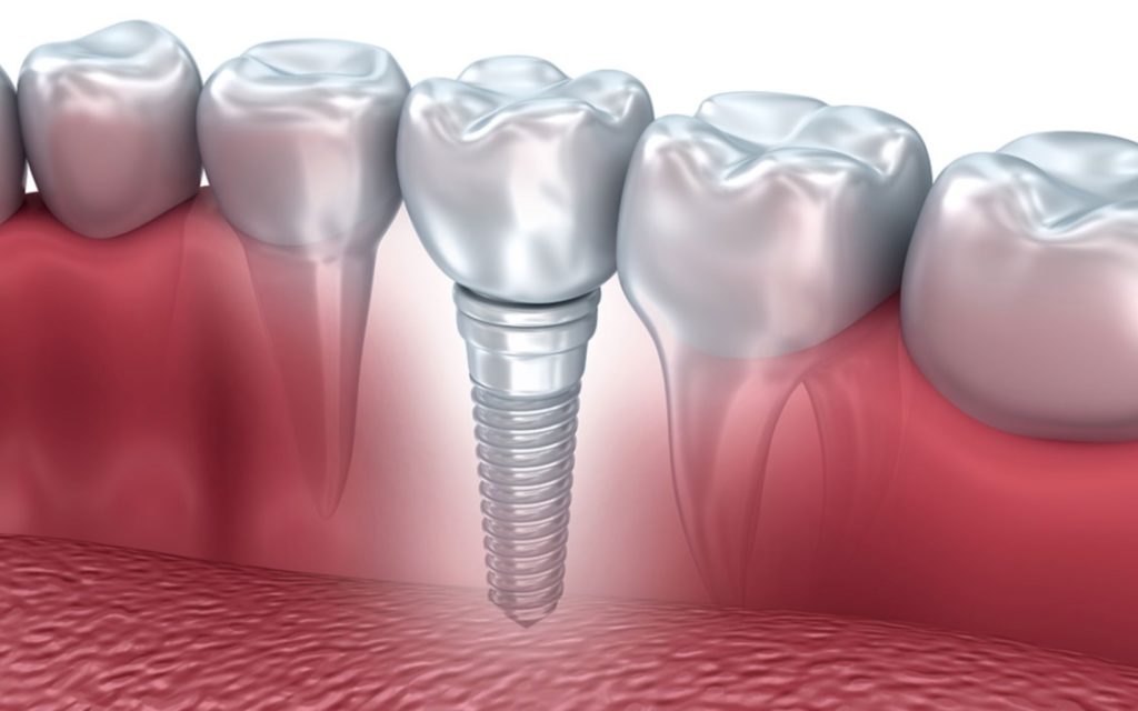 implant dentaire